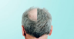 Laser Treatment For Hair Loss: Does it work?