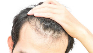The Best Hair Loss Treatments At Home