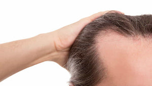 Who Can I Trust To Give Me The Best Hair Loss Treatment At A Reasonable Cost?