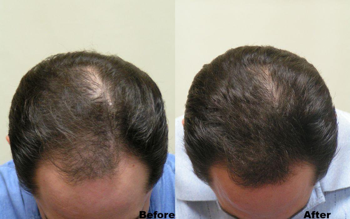 hair loss before and after